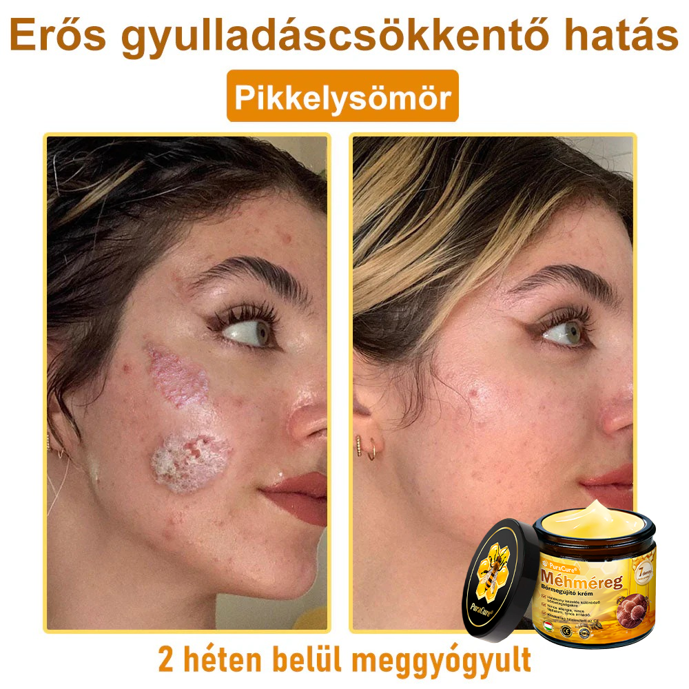 ⭐⭐⭐⭐𝐏𝐮𝐫𝐚𝐂𝐮𝐫𝐞® 𝐌é𝐡𝐦é𝐫𝐞𝐠 𝐁ő𝐫 𝐇𝐞𝐥𝐲𝐫𝐞á𝐥𝐥í𝐭ó 𝐊𝐫é𝐦 (👨‍⚕‍𝐂𝐄 𝐓𝐚𝐧ú𝐬í𝐭𝐯á𝐧𝐲)👍✅Magyar fejlesztés, magyarországi gyártás és szállítás