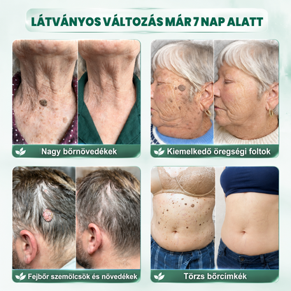🔥𝐏𝐮𝐫𝐚𝐂𝐮𝐫𝐞® 𝐌𝐈𝐊𝐑𝐎𝐓Ű𝐒 𝐁Ő𝐑𝐊𝐈𝐍Ö𝐕É𝐒-𝐄𝐋𝐓Á𝐕𝐎𝐋Í𝐓Ó 𝐓𝐀𝐏𝐀𝐒𝐙𝐎𝐊 —𝟕 𝐍𝐀𝐏𝐎𝐒 𝐂É𝐋𝐙𝐎𝐓𝐓 𝐄𝐋𝐓Á𝐕𝐎𝐋Í𝐓Á𝐒 𝐁Ő𝐑𝐍𝐘Ú𝐋𝐕Á𝐍𝐘𝐎𝐊, 𝐒𝐙𝐄𝐌Ö𝐋𝐂𝐒Ö𝐊 É𝐒 𝐊𝐈𝐄𝐌𝐄𝐋𝐊𝐄𝐃Ő 𝐁Ő𝐑𝐇𝐈𝐁Á𝐊 𝐄𝐋𝐋𝐄𝐍
