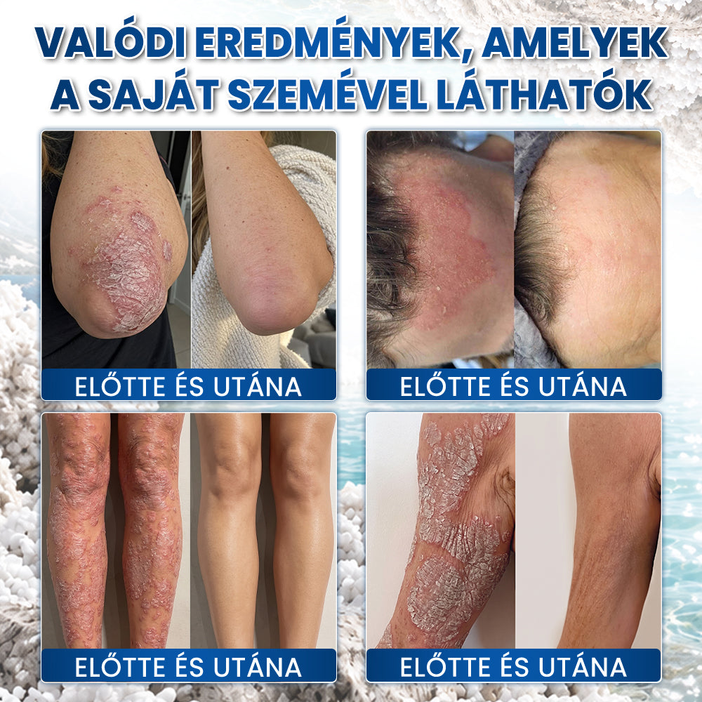 ❤️Medistart® PSZORIÁZIS SPECIÁLIS BŐRÁPOLÓ