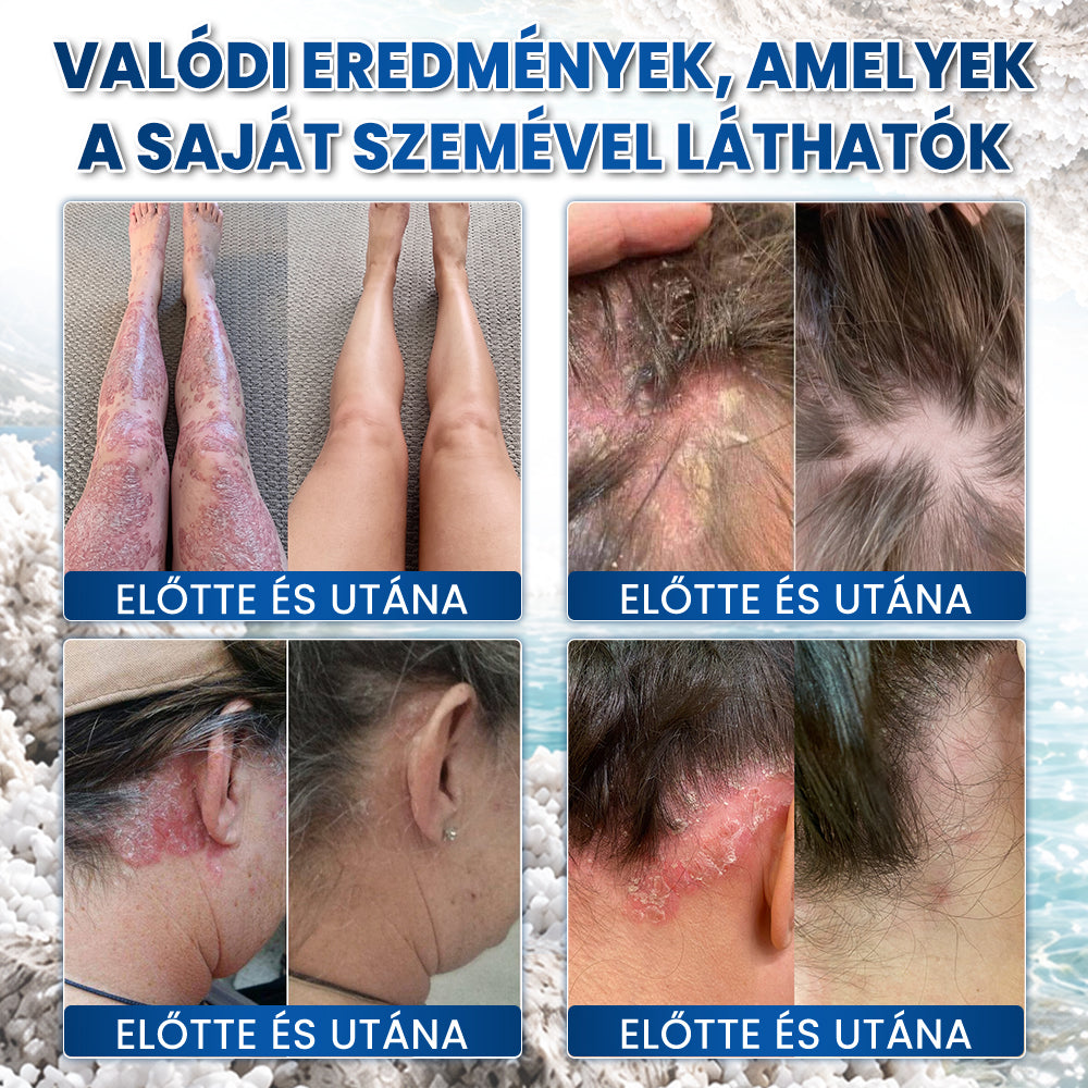 ❤️Medistart® PSZORIÁZIS SPECIÁLIS BŐRÁPOLÓ