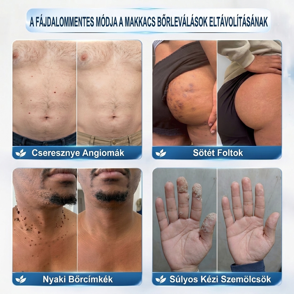 🍀PuraCure® 👩‍⚕️ 𝟕 𝐍𝐚𝐩𝐨𝐬 Bőrkinövés- és Folteltávolító Toll Fájdalommentes és Hegmentes Professzionális Rollerball