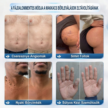 🍀PuraCure® 👩‍⚕️ 𝟕 𝐍𝐚𝐩𝐨𝐬 Bőrkinövés- és Folteltávolító Toll Fájdalommentes és Hegmentes Professzionális Rollerball