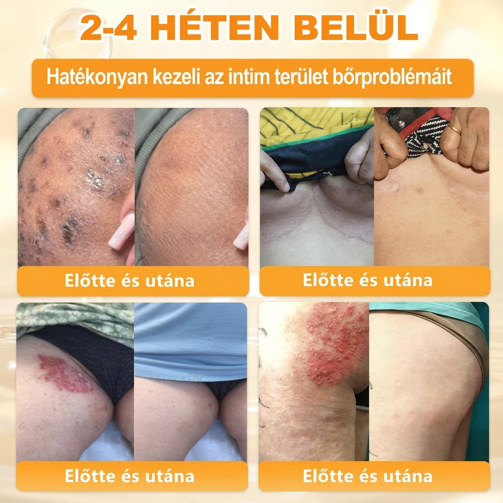 🌟𝐏𝐮𝐫𝐚𝐂𝐮𝐫𝐞® 𝐌é𝐡𝐦é𝐫𝐞𝐠 𝐁ő𝐫 𝐇𝐞𝐥𝐲𝐫𝐞á𝐥𝐥í𝐭ó 𝐊𝐫é𝐦 (👨‍⚕‍𝐂𝐄 𝐓𝐚𝐧ú𝐬í𝐭𝐯á𝐧𝐲)👍✅Magyar fejlesztés, magyarországi gyártás és szállítás