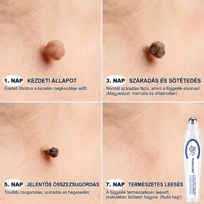🍀PuraCure® 👩‍⚕️ 𝟕 𝐍𝐚𝐩𝐨𝐬 Bőrkinövés- és Folteltávolító Toll Fájdalommentes és Hegmentes Professzionális Rollerball