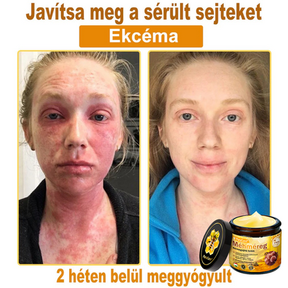 ⭐⭐⭐⭐𝐏𝐮𝐫𝐚𝐂𝐮𝐫𝐞® 𝐌é𝐡𝐦é𝐫𝐞𝐠 𝐁ő𝐫 𝐇𝐞𝐥𝐲𝐫𝐞á𝐥𝐥í𝐭ó 𝐊𝐫é𝐦 (👨‍⚕‍𝐂𝐄 𝐓𝐚𝐧ú𝐬í𝐭𝐯á𝐧𝐲)👍✅Magyar fejlesztés, magyarországi gyártás és szállítás