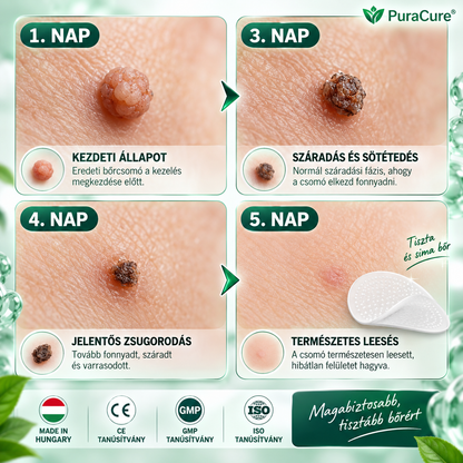🔥𝐏𝐮𝐫𝐚𝐂𝐮𝐫𝐞® 𝐌𝐈𝐊𝐑𝐎𝐓Ű𝐒 𝐁Ő𝐑𝐊𝐈𝐍Ö𝐕É𝐒-𝐄𝐋𝐓Á𝐕𝐎𝐋Í𝐓Ó 𝐓𝐀𝐏𝐀𝐒𝐙𝐎𝐊 —𝟕 𝐍𝐀𝐏𝐎𝐒 𝐂É𝐋𝐙𝐎𝐓𝐓 𝐄𝐋𝐓Á𝐕𝐎𝐋Í𝐓Á𝐒 𝐁Ő𝐑𝐍𝐘Ú𝐋𝐕Á𝐍𝐘𝐎𝐊, 𝐒𝐙𝐄𝐌Ö𝐋𝐂𝐒Ö𝐊 É𝐒 𝐊𝐈𝐄𝐌𝐄𝐋𝐊𝐄𝐃Ő 𝐁Ő𝐑𝐇𝐈𝐁Á𝐊 𝐄𝐋𝐋𝐄𝐍